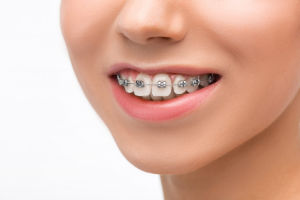 Mersin Diş Teli Ortodonti